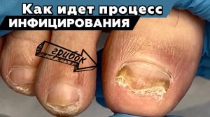 Грибок ногтей. Как все начинается