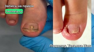 Как спасти вросший ноготь у ребенка