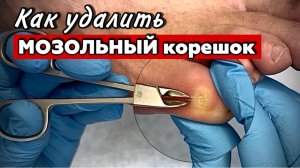 Удаление стержневой мозоли на мизинце