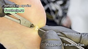 Сухая мозоль на стопе
