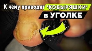 Сложное врастание боковых стенок ногтя