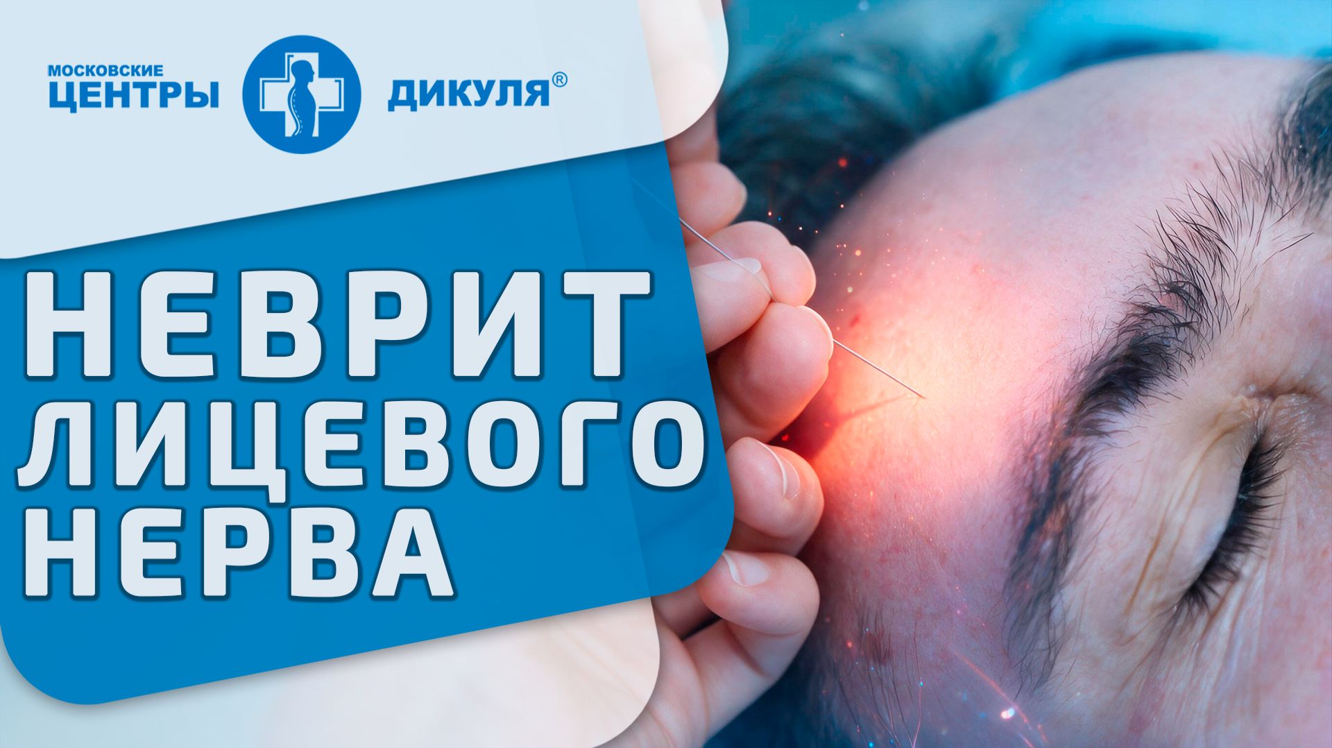 📍Неврит лицевого нерва - когда помогает иглоукалывание? Неврит лицевого нерва. Москва МРТ, невролог