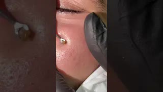 Удаление одного черного угря #skincare #shorts #viral