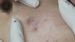 #977 Удаление акне. Экстракция комедонов. Подкожные прыщи. Чистка от черных точек