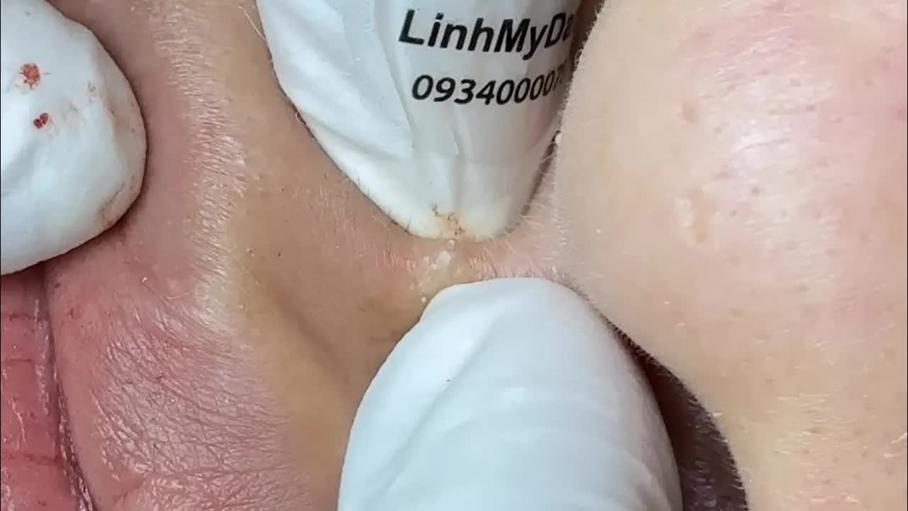 Расслабляющая чистка лица от прыщей в спа LinhMyDang