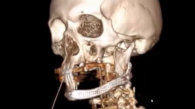 Онкологи Татарстана восстановили челюсть пациентке с помощью 3D-импланта