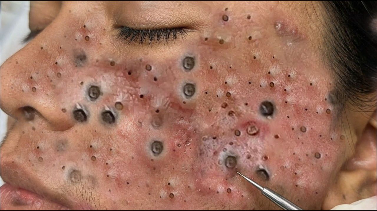 Выдавливание прыщей. «слабонервным не смотреть»