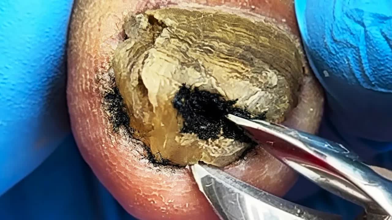 Специализированный педикюр: глубокая чистка утолщённых ногтей【Подологическая клиника】