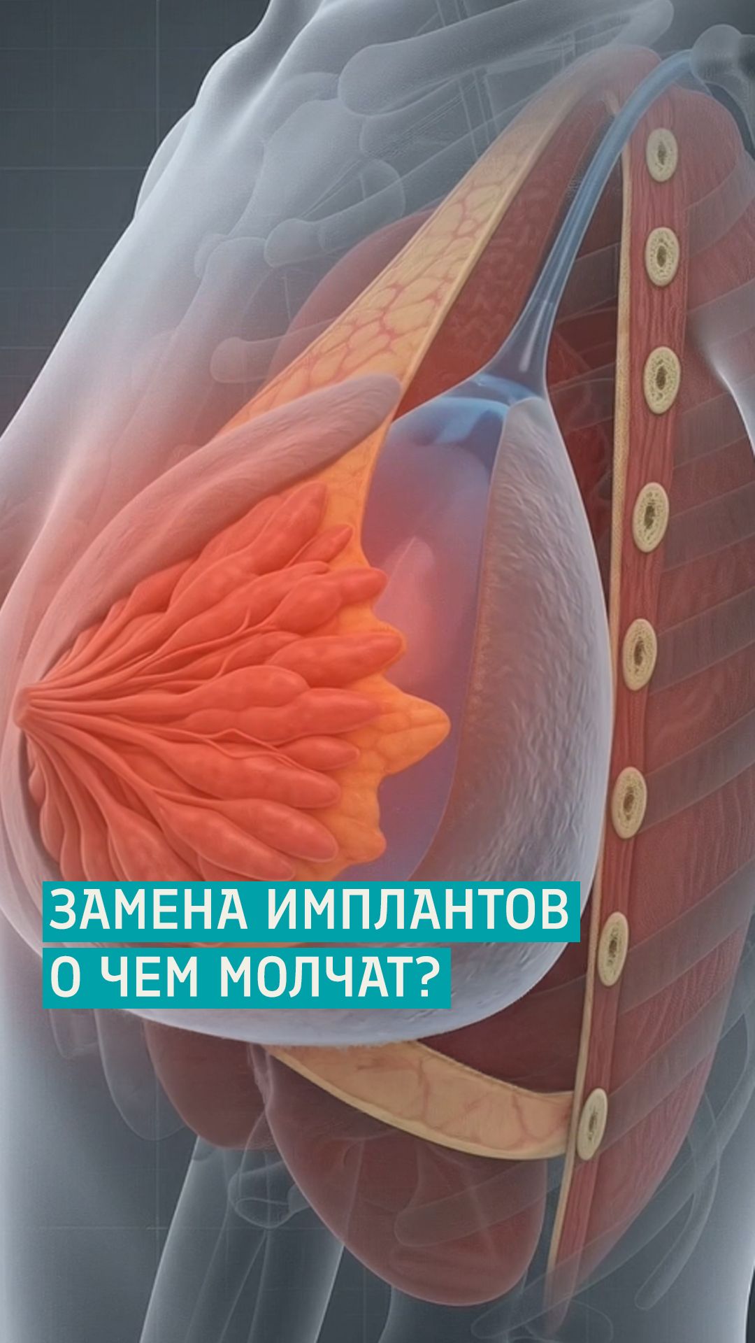 Что важно знать о замене силиконовых имплантов? / Увеличение груди / Протасов Кирилл Андреевич