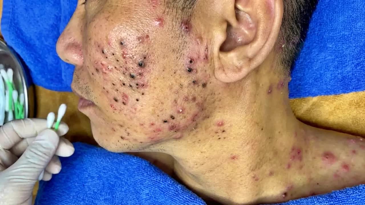 Удаление черных точек в спа-салоне