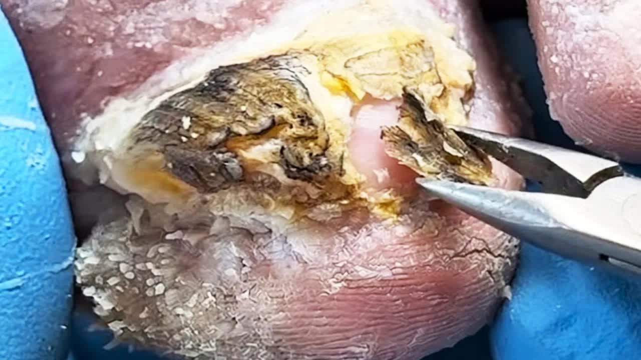Удовлетворительный педикюр: стрижка твердых ногтейPedicure King
