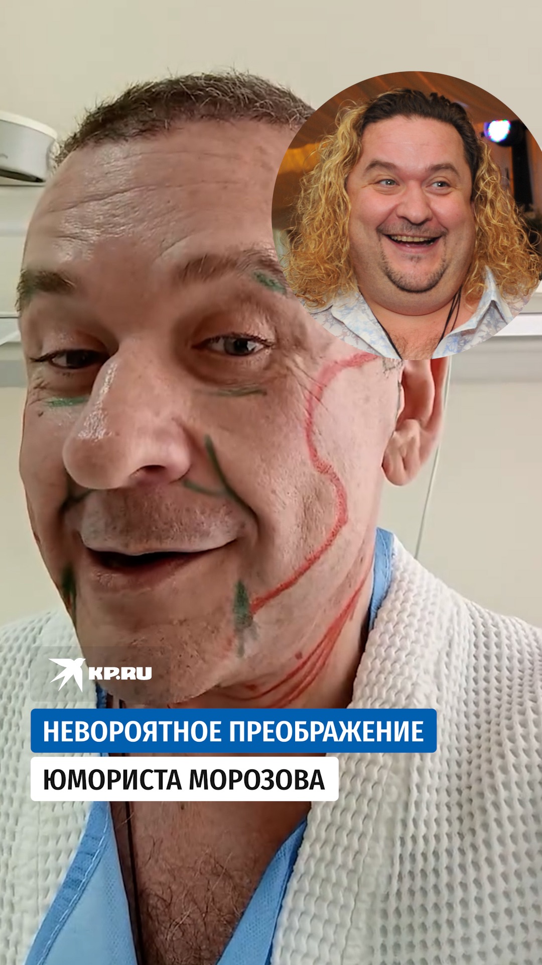 Александр Морозов из «Кривого зеркала» показал лицо после пластики