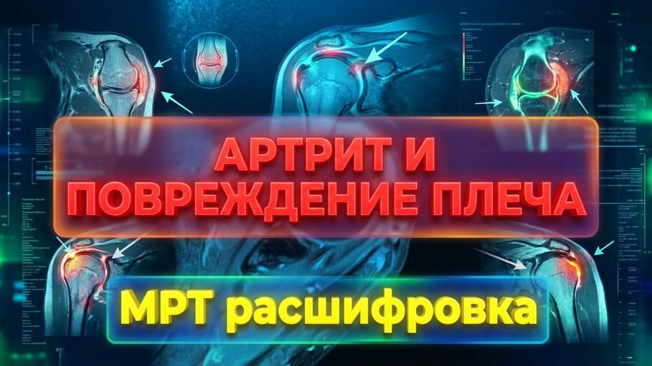Признаки ТРАВМЫ плеча, АРТРОЗО АРТРИТ и разрыв суставной губы на РАСШИФРОВКЕ МРТ плечевого сустава