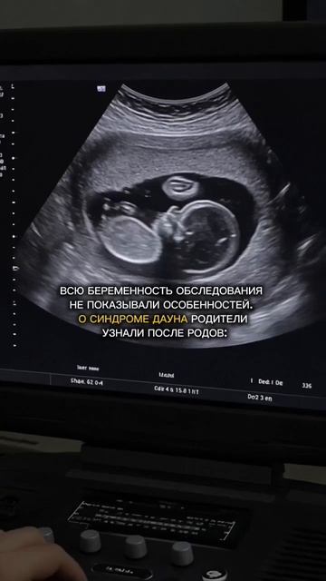 Синдром Дауна : как определить