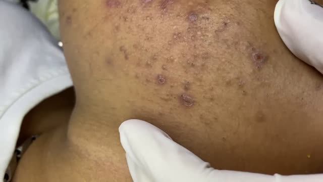 Чистка лица – удаление прыщей и чёрных точек