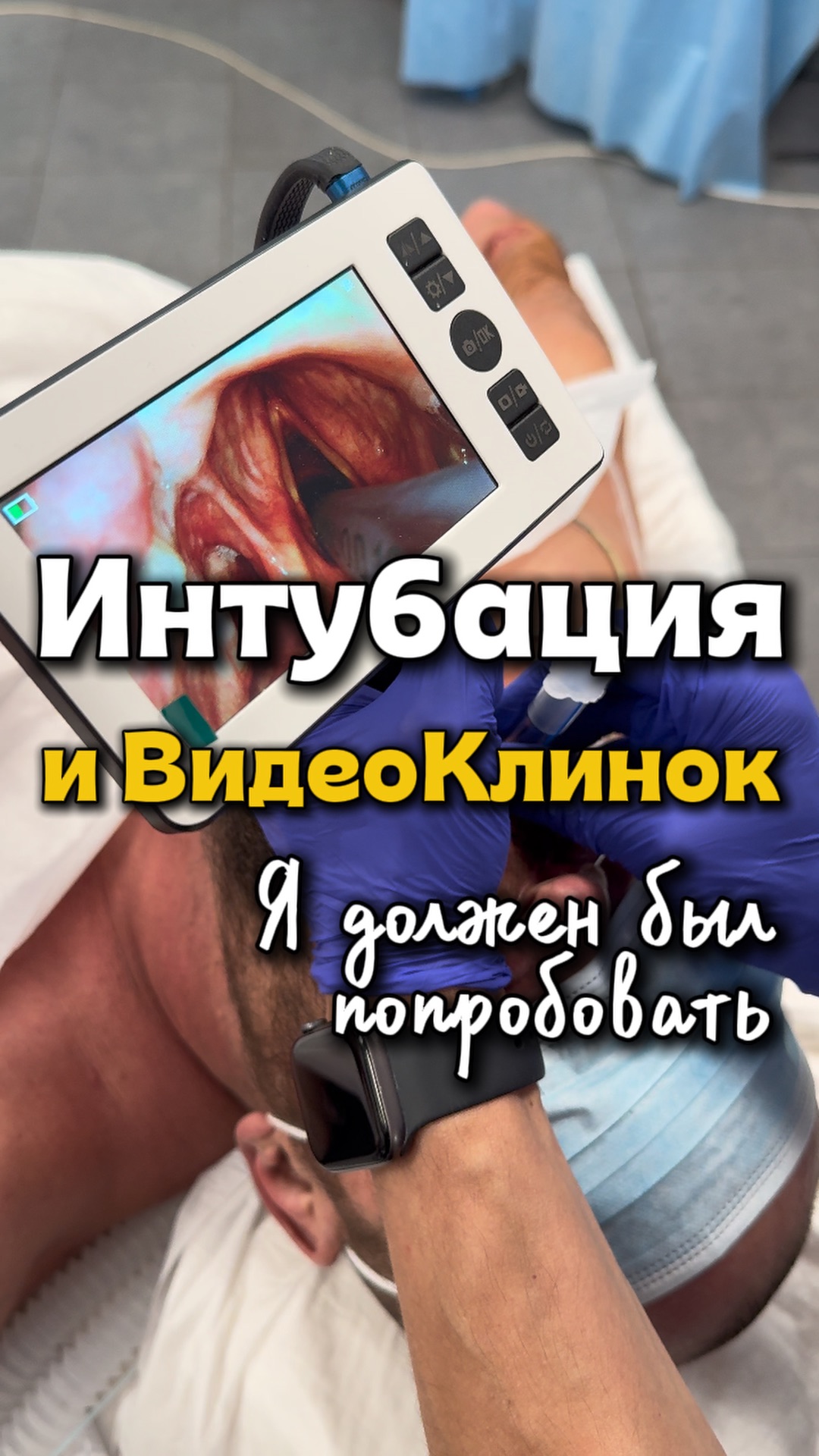 ИНТУБАЦИЯ ТРАХЕИ  GA VL  ригидный стилет