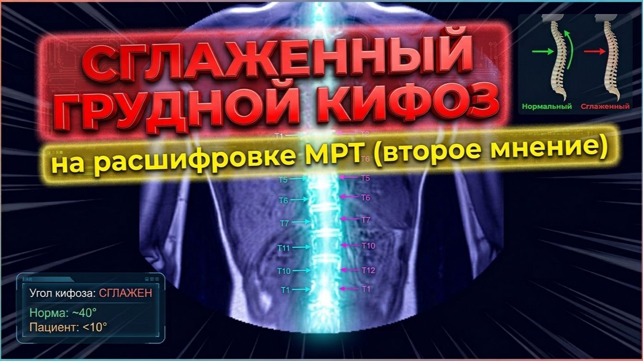 БОЛИ в грудном отделе, СГЛАЖЕННЫЙ КИФОЗ грудного отдела и правостороннем СКОЛИОЗЕ на РАСШИФРОВКЕ МРТ