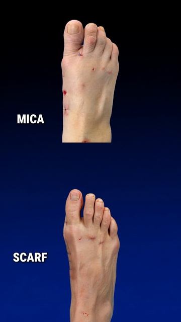 Scarf Vs Mica при Hallux Valgus