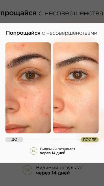 MIXIT Очищающие пилинг диски пэды 'Stop Acne Face Pads', для проблемной кожи, 250мл   купить в интер