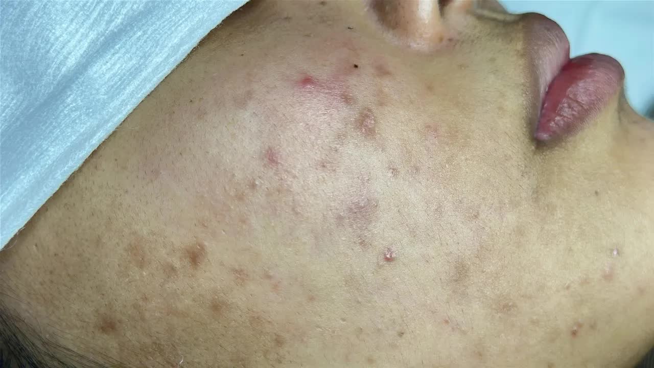Расслабляющее удаление акне в спа LinhMyDang