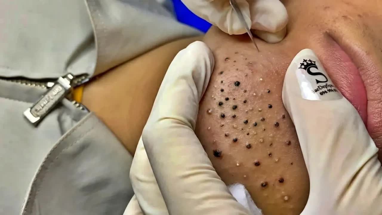 Удаление чёрных точек с Sac Dep Spa