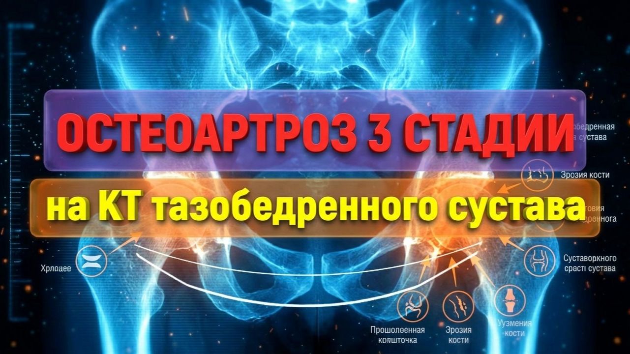 ИМПИДЖМЕНТ синдром тазобедренном суставе, ДЕФОРМИРУЮЩИЙ ОСТЕОАРТРОЗ тазобедренного сустава 3 степени