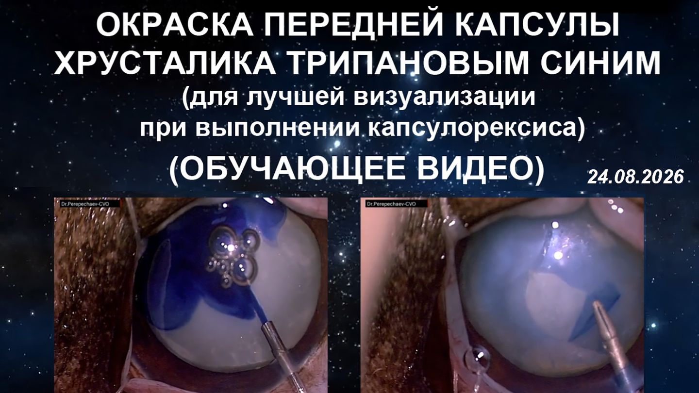 Окраска передней капсулы хрусталика трипановым синим. Обучающее видео.