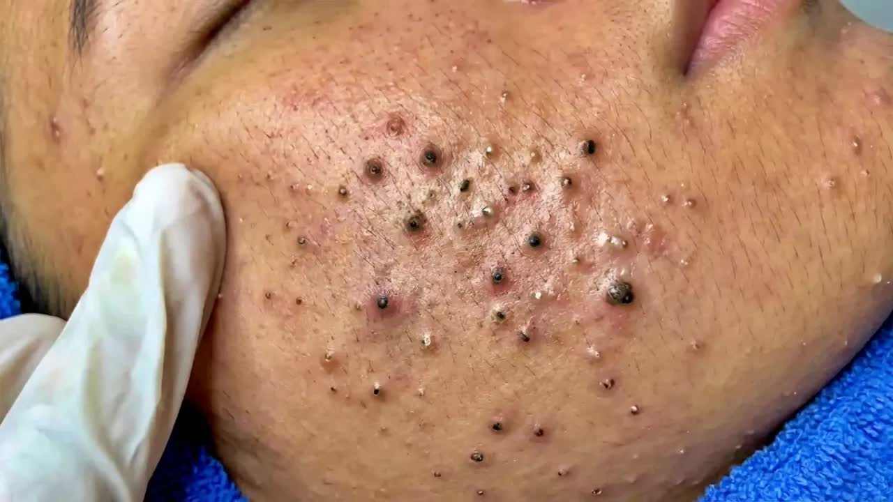 Удаление черных точек с Sac Dep Spa