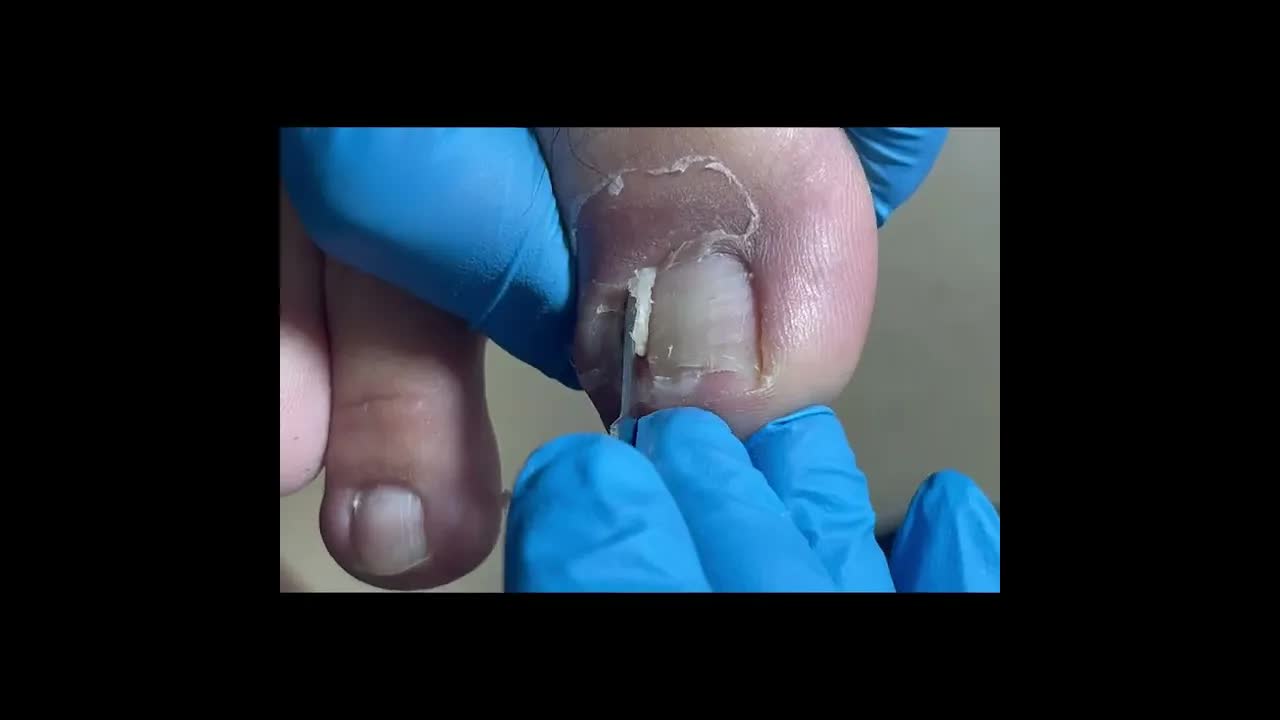 Крупные куски вросшего ногтя срезаны. nails педикюр