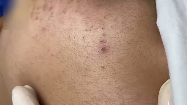 Удаление акне  возвращаем коже красоту