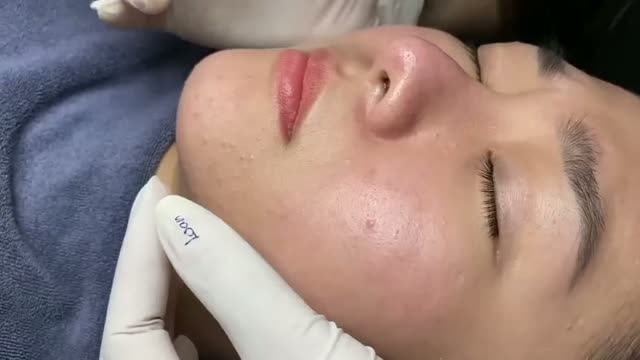 Удаление акне – для любой кожи