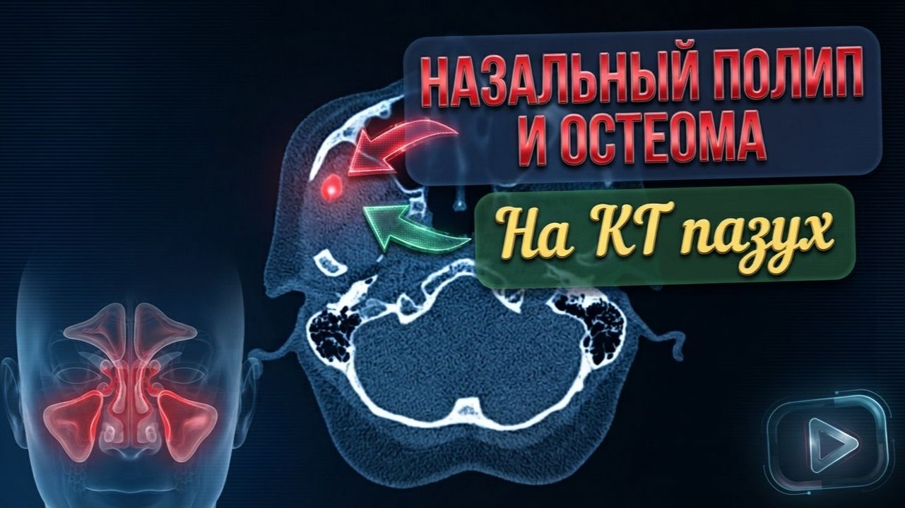ОСТЕОМА решетчатой пазухи и ПОЛИПОЗНЫЙ СИНУСИТ (полип носа) на РАСШИФРОВКЕ КТ придаточных пазух носа