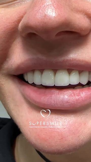 Установка виниров в клиникe Super Smile в Санкт-Петербурге