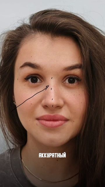 Вторичная ринопластика, год спустя. Разбор кейса доктора Поздникиной
