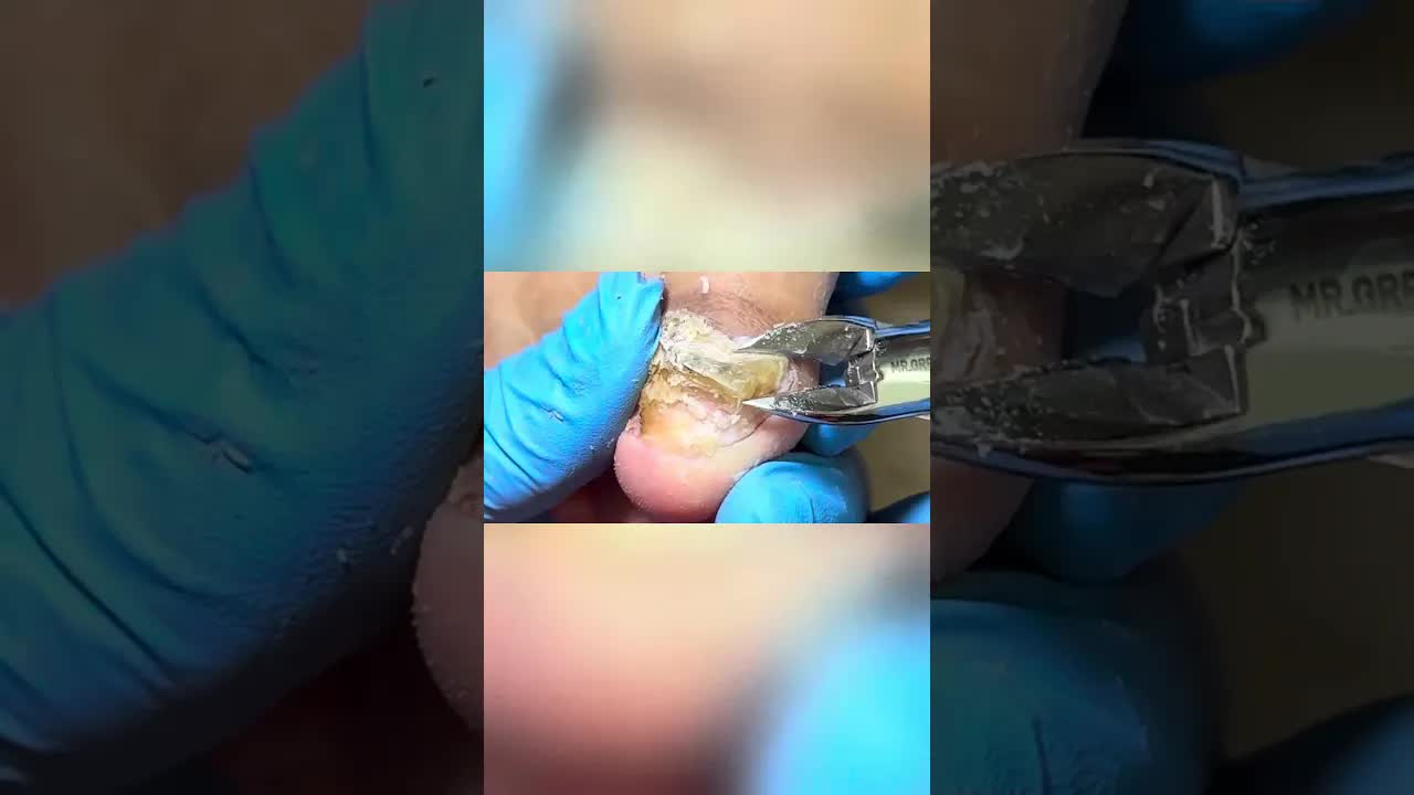 Зеленый онихомикоз, стрижка шаг за шагом~