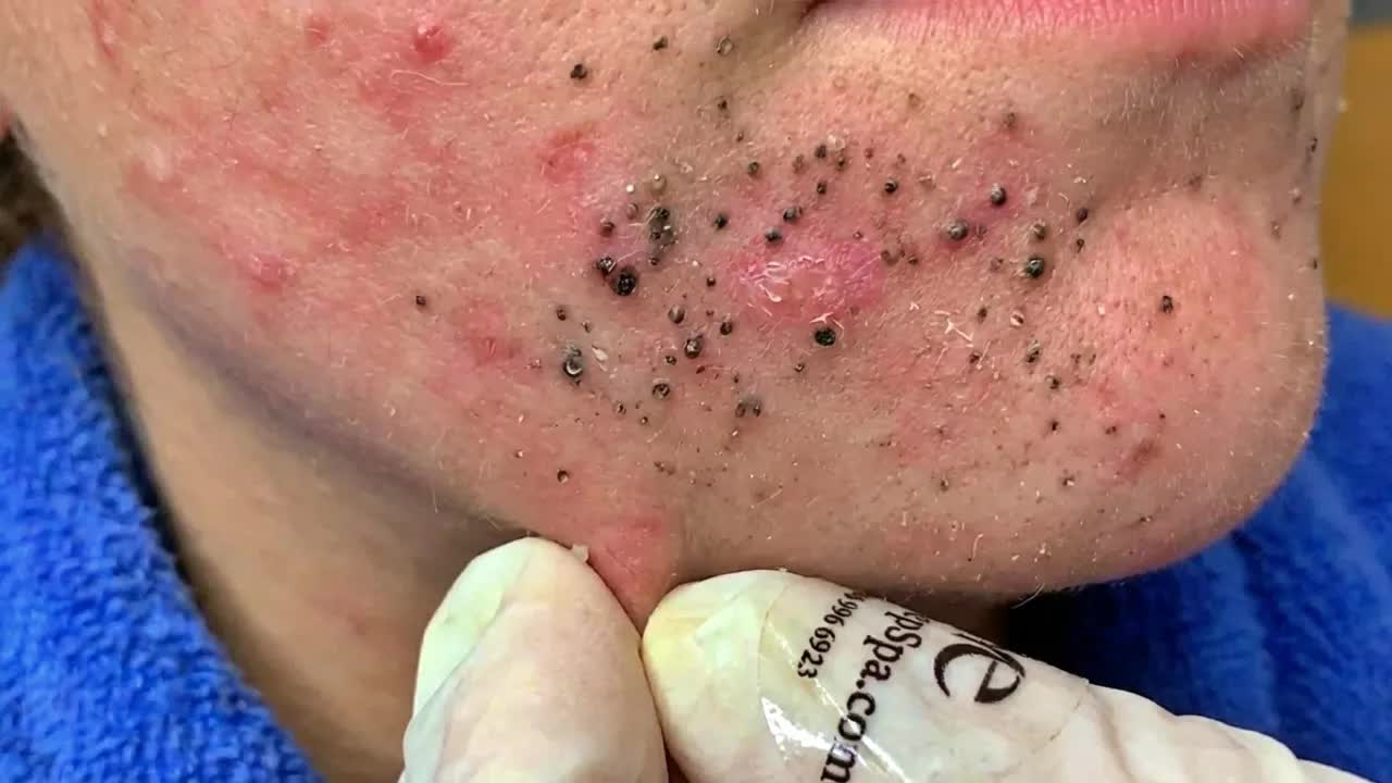 Удаление чёрных точек в SPA-салоне