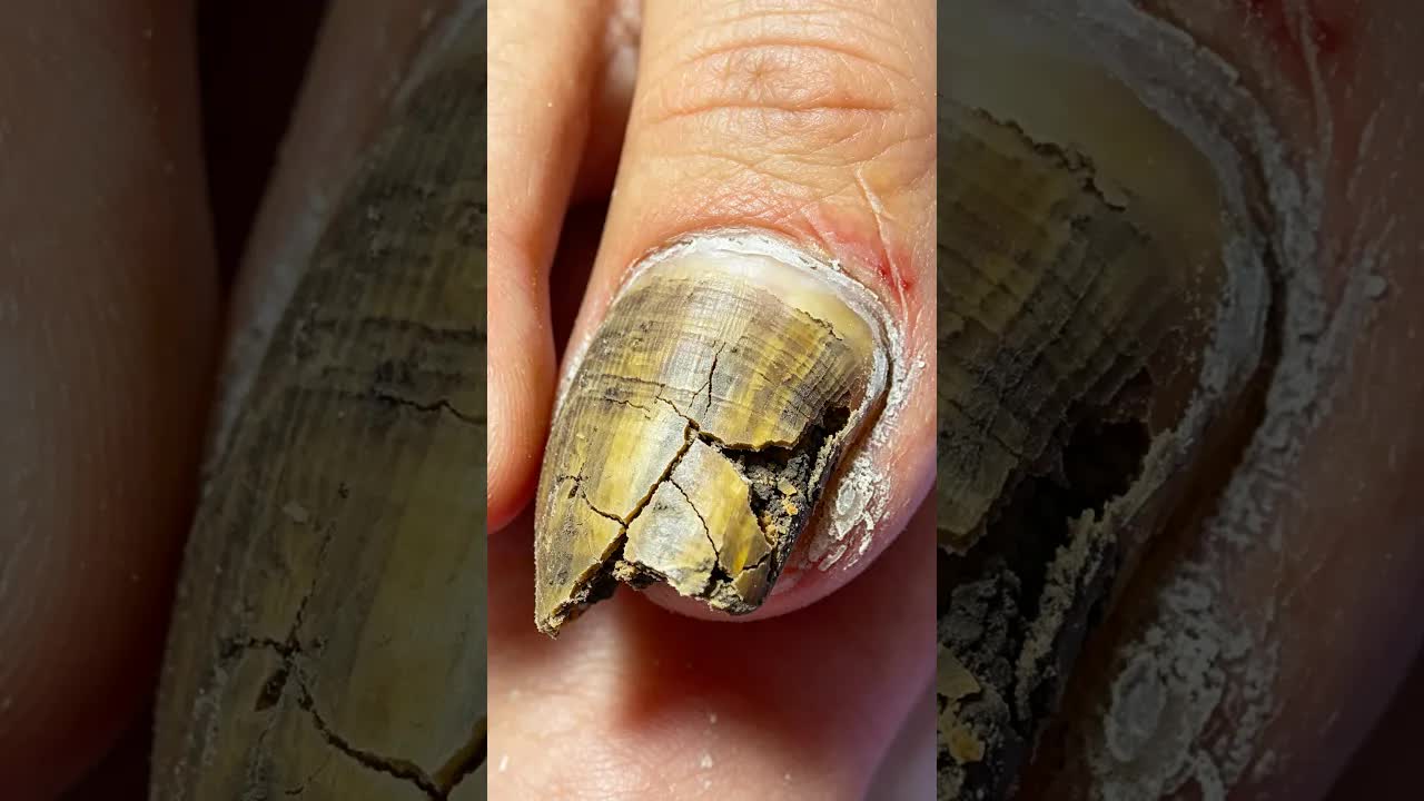 Зелёный онихомикоз, стрижка пошагово~ #satisfying #foot #nails #pedicure