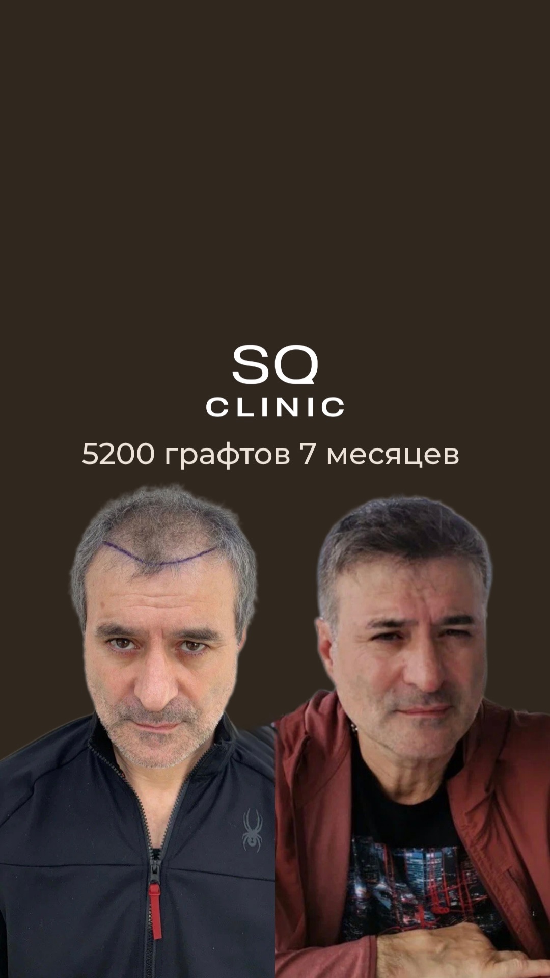 Поредение в лобной области — не приговор, а задача, которую можно решить.