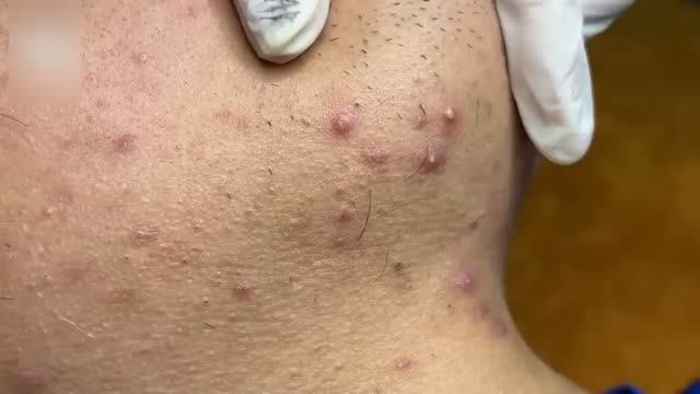 #1010 Удаление акне. Экстракция комедонов. Подкожные прыщи. Чистка от черных точек