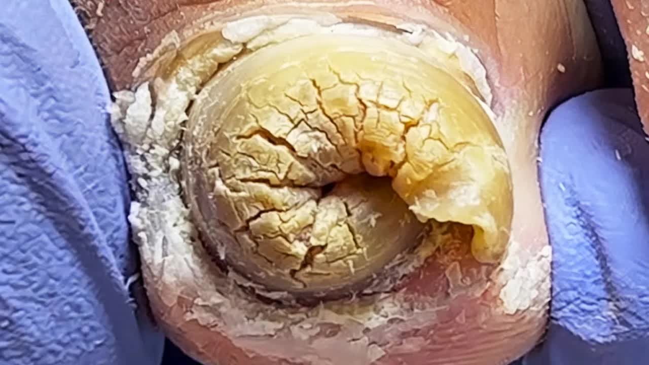 Профессиональный педикюр: полный уход за деформированными утолщенными ногтямиПодологическая