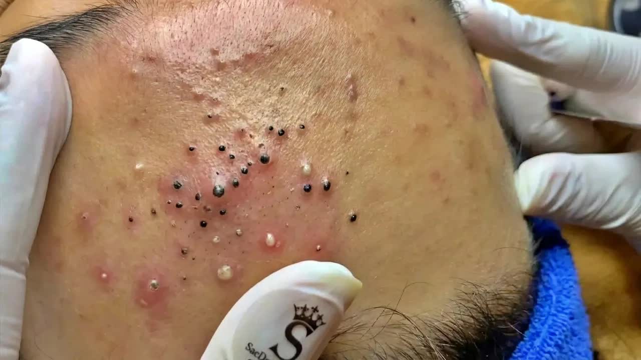 Удаление чёрных точек с помощью Sac Dep Spa