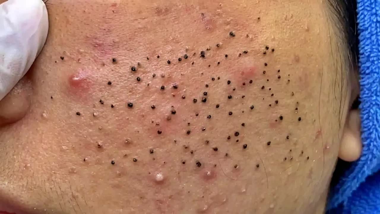 Удаление чёрных точек в спа-салоне Today