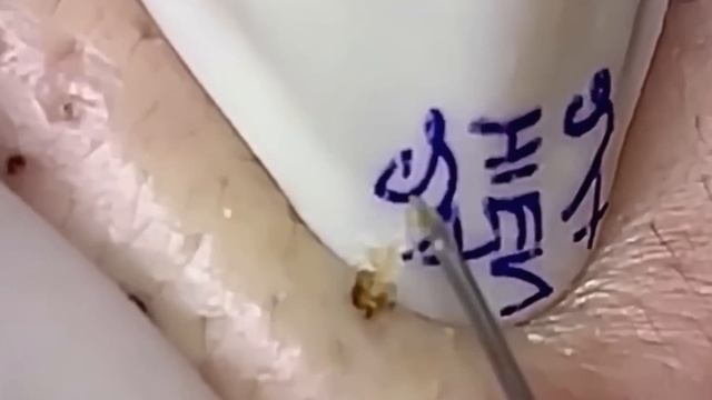 #1229 Удаление комедонов, угрей и прыщей — глубокое очищение кожи