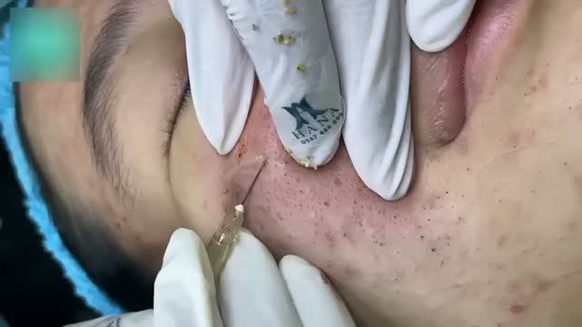 Чистка лица  удаление акне и чёрных точек