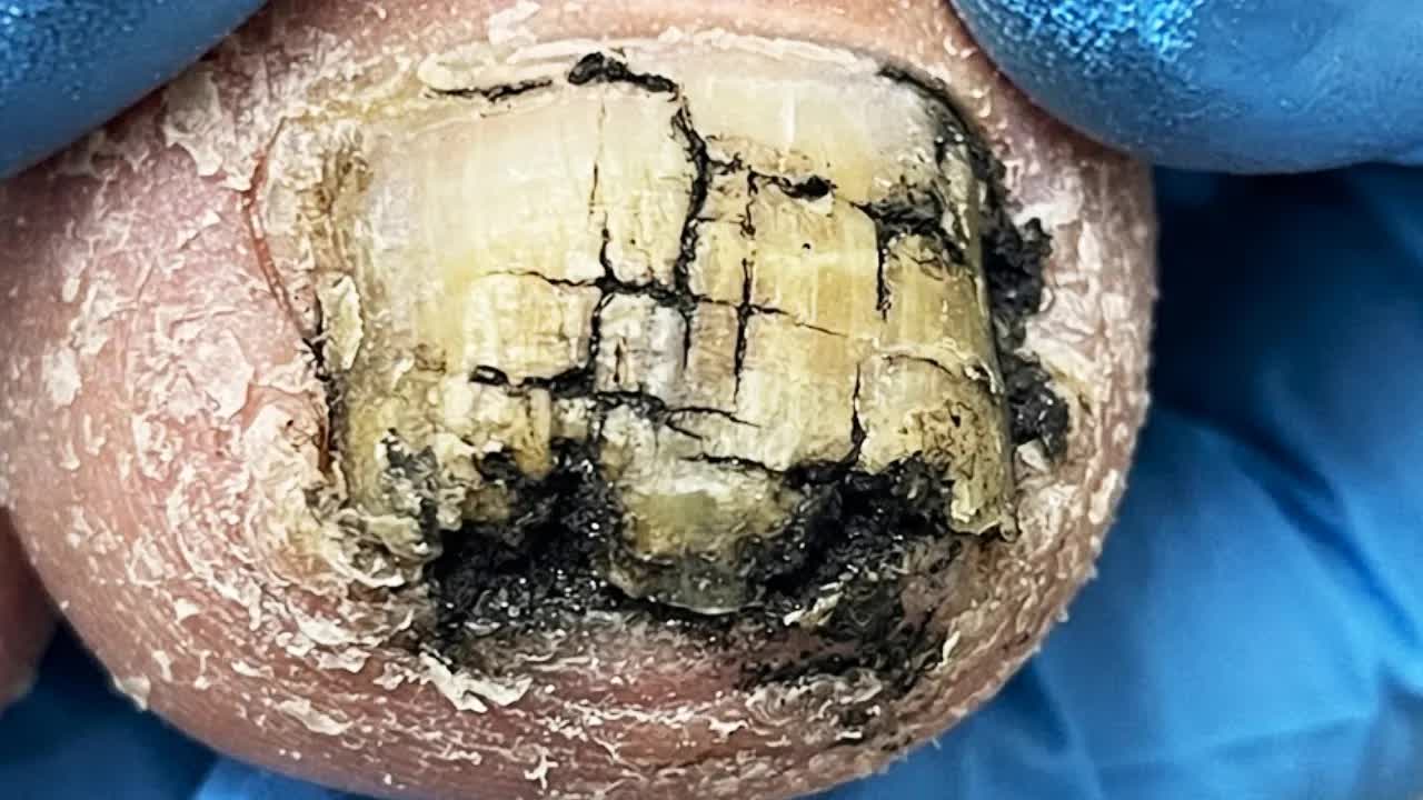 Подробная чистка желтых грибковых ногтей шаг за шагомКороль педикюра