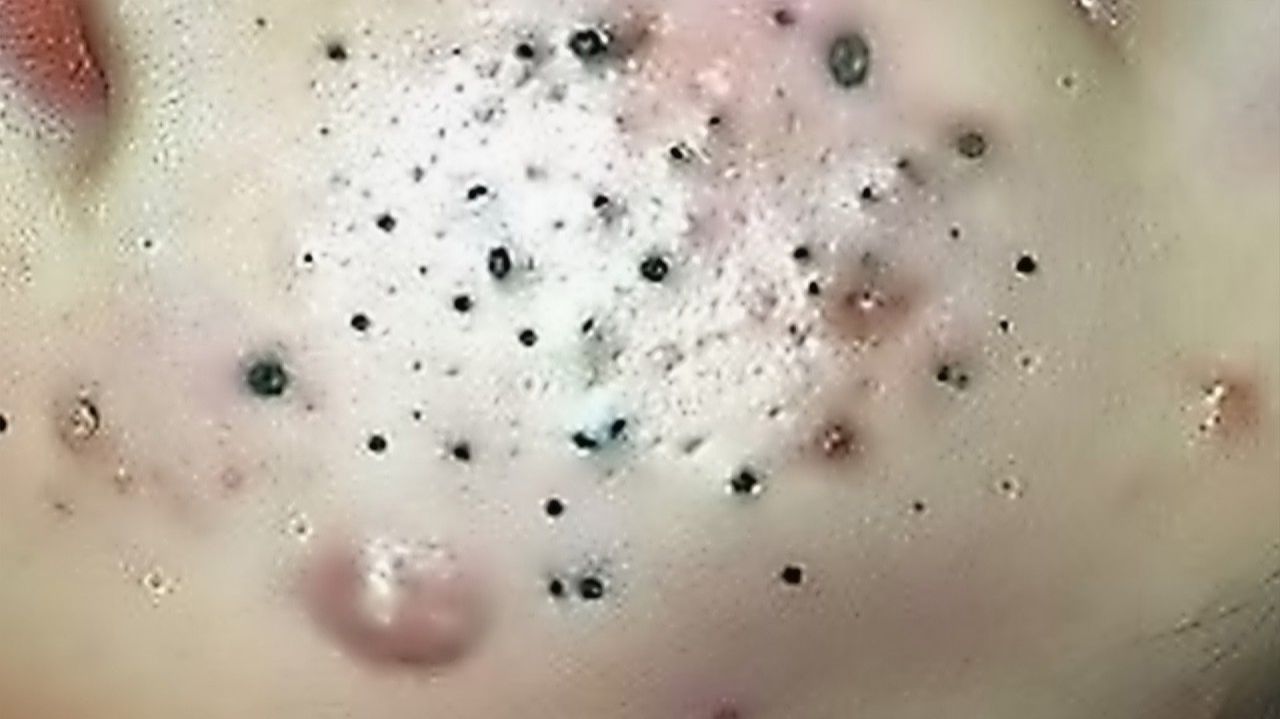 Выдавливание прыщей. НОВОЕ! Угри. Акне. чистка лица.