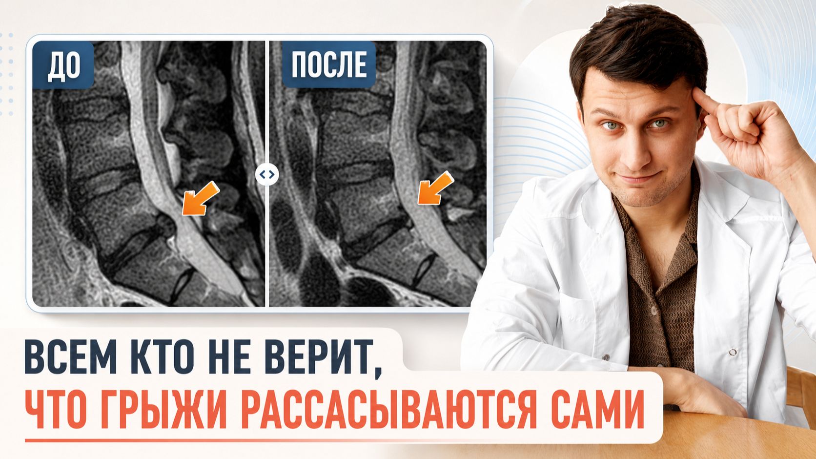 Вот как рассасываются межпозвонковые грыжи: разбор МРТ реального пациента с резорбцией