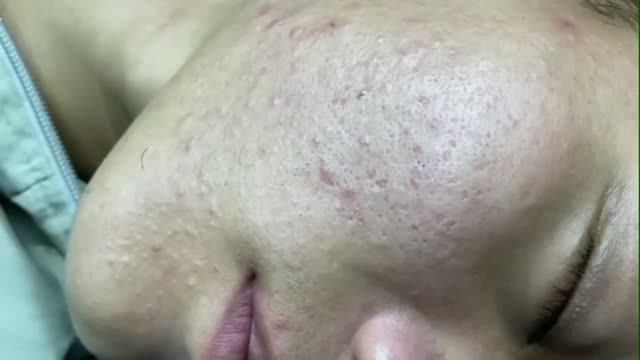 #1003 Удаление акне. Экстракция комедонов. Подкожные прыщи. Чистка от черных точек