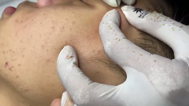 Удаление акне – чистая кожа в короткие сроки