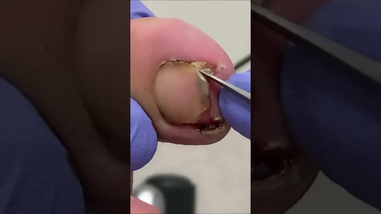 Под ногтем скопилось много грязи чистка nails pedicure